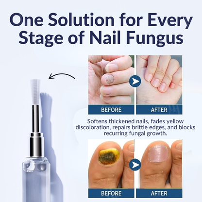 AEXZR® Next-Gen Antifungal Max-Pen