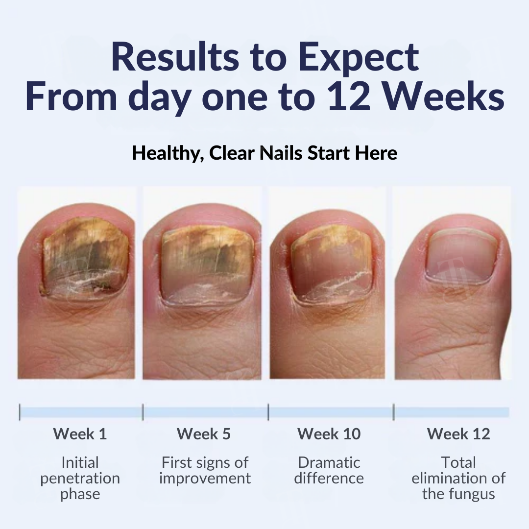 AEXZR® Next-Gen Antifungal Max-Pen