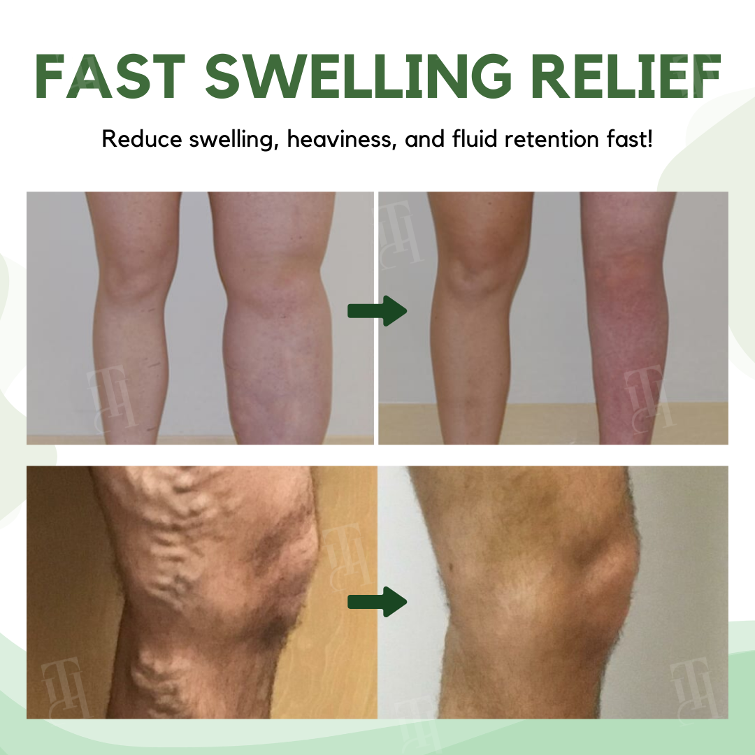 Limited Stock!!⚡RZXEA™ Next-Gen Lymphatic Drainage & Vein Repair Cream